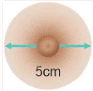 5 cm Areolas